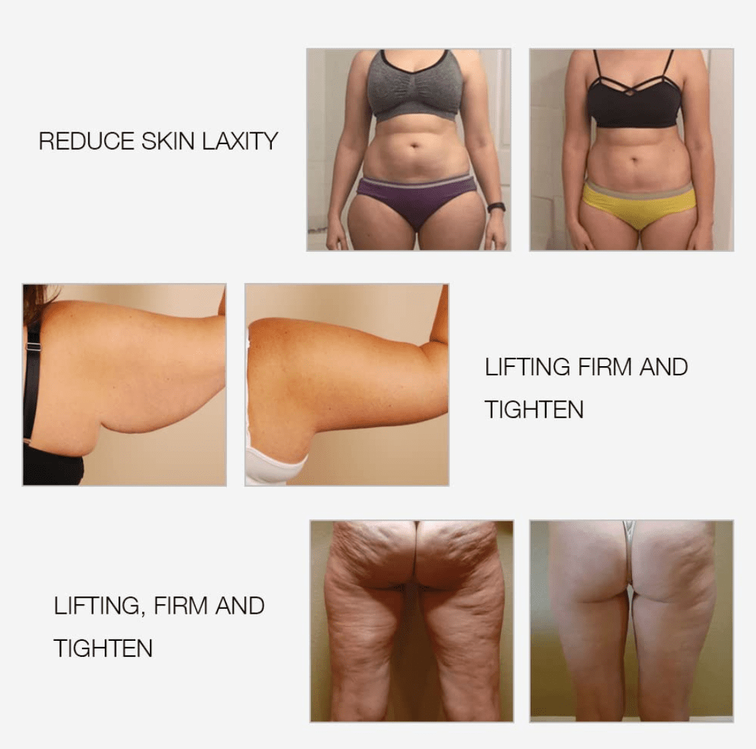 RF Radio Frequency Facial And Body Skin Tightening Machine,Professional Home RF Skin Care Anti Aging Device - Image 3