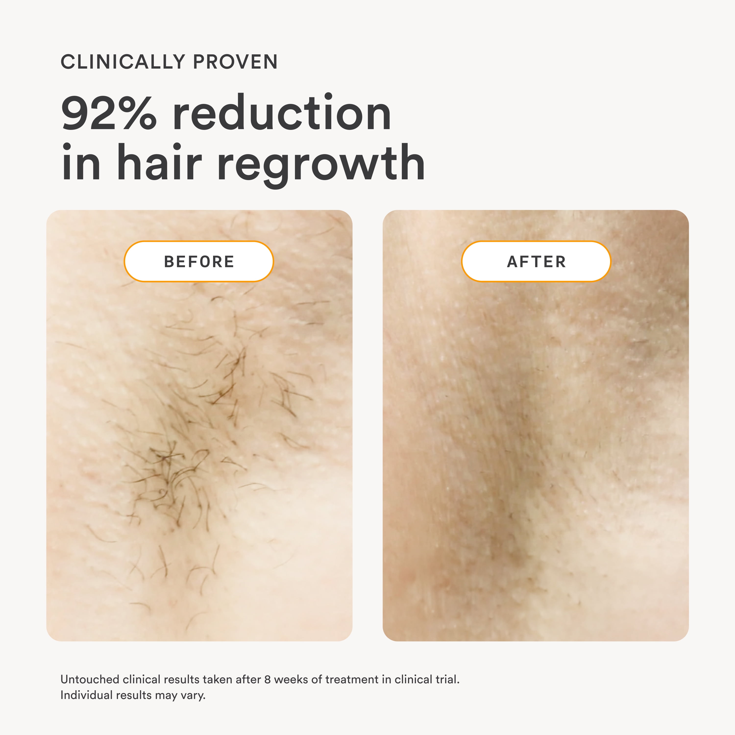 Nood Flasher 2.0 — IPL Laser Hair Removal Device for Women & Men — Pain-Free & Permanent Results - Image 4